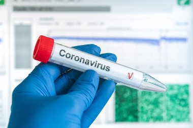 Corona virüs testi ya da COVID-19 testi. Eldivenler, üzerinde korona virüsü test etiketi olan bir test tüpü taşıyor. Arka plandaki analiz verileri. SARS-CoV-2 test konsepti.