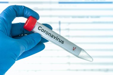 COVID-19 testi. Eldivenler, üzerinde korona virüsü test etiketi olan bir test tüpü taşıyor. Arka plandaki analiz verileri. SARS-CoV-2 test konsepti.