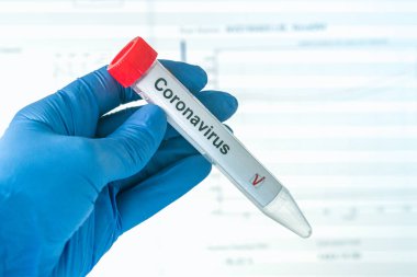 Corona virüs testi ya da COVID-19 testi. Eldivenler, üzerinde korona virüsü test etiketi olan bir test tüpü taşıyor. Arka plandaki analiz verileri. SARS-CoV-2 test konsepti.
