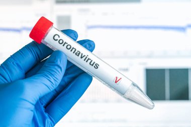 Corona virüs testi ya da COVID-19 testi. Eldivenler, üzerinde korona virüsü test etiketi olan bir test tüpü taşıyor. Arka plandaki analiz verileri. SARS-CoV-2 test konsepti.