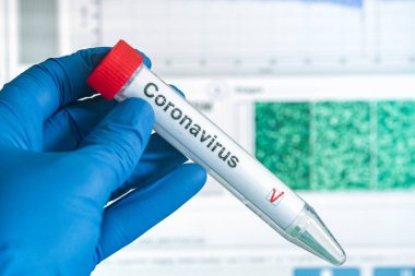 COVID-19 testi. Eldivenler, üzerinde korona virüsü test etiketi olan bir test tüpü taşıyor. Arka plandaki analiz verileri. SARS-CoV-2 test konsepti.