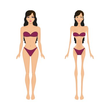 Vektör illüstrasyon kadın anoreksiya. Kadınlar bulimia