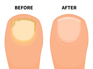 Vector toe nail before and after fungal disease clipart