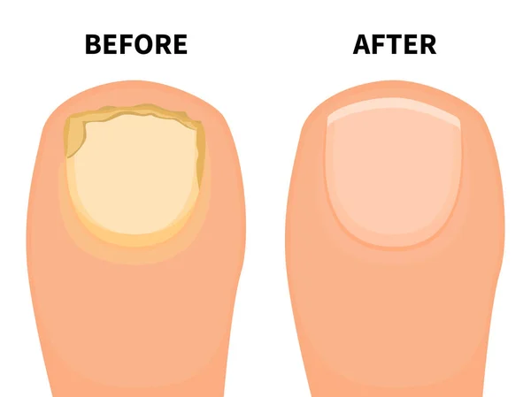 Vector toe nail before and after fungal disease — Stock Vector