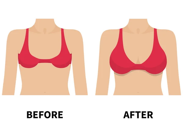 Mama feminina antes e depois da cirurgia plástica —  Vetores de Stock