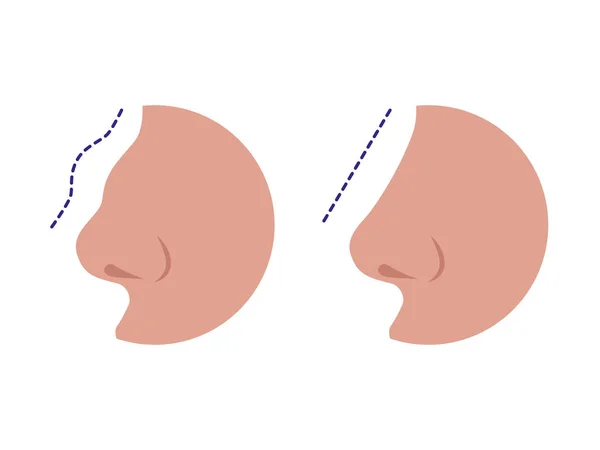 Нос до и после коррекции ринопластики — стоковый вектор
