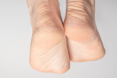 Beyaz arka planda kurumuş ve çatlak ayak topukları. Beyaz arkaplanda kadın topukları