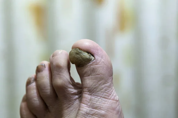 Big toe with fungal nail infection Royalty Free Stock Images