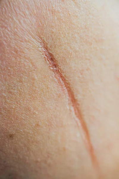 Large scar on on face the cheek of a man. Mangle, wound, cut of a knife. Unrecognizable. — Stock Photo, Image
