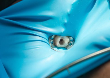 Diş hekimliği, tedavi süreci. Doktor ve tıp teknisyeni yetişkin hastayı tedavi ediyor, dişe yakın çekimde diş boşluğu ve aletlerle elleri var. Kanal tedavisi ya da derin tedavi.