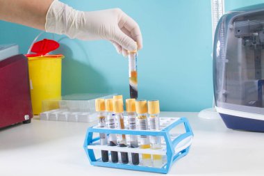Eldiven içinde, tıp laboratuarındaki bilim adamı kan örneğini test tüpünde tutuyor. Test laboratuarında daha fazla kan ve idrar örneği alın. Yeni koronavirüs örnekleri üzerinde laboratuvar çalışması.
