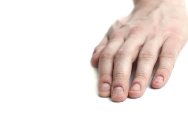 Tırnak hasarı. Tırnaklarını yemiş. Erkek manikürü. Tırnak tabağı sorunları. Erkek eli. Beyaz bir arkaplanda izole edilmiş.