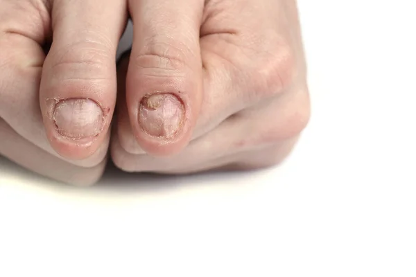 Tırnak hasarı. Tırnaklarını yemiş. Erkek manikürü. Tırnak tabağı sorunları. Erkek eli. Beyaz bir arkaplanda izole edilmiş.