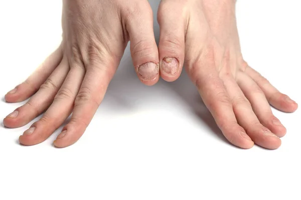 Βλάβη Στα Νύχια Δαγκωμένα Νύχια Μανικιούρ Πρόβλημα Στην Πλάκα Νυχιών — Φωτογραφία Αρχείου