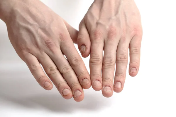 Danos Nas Unhas Unhas Mordidas Manicura Homem Problemas Com Placa — Fotografia de Stock