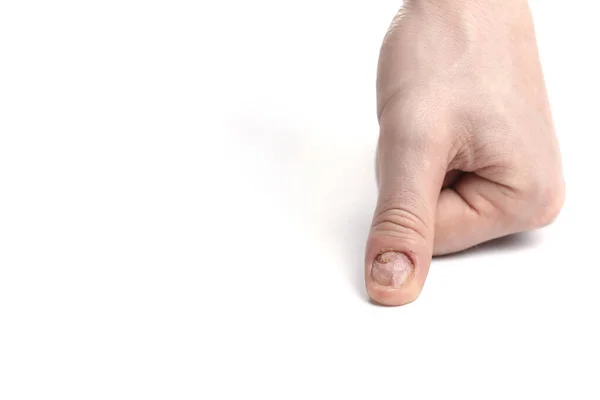 Man Nail Damage Bitten Nails Man Manicure Nail Plate Problems — Stock Photo, Image