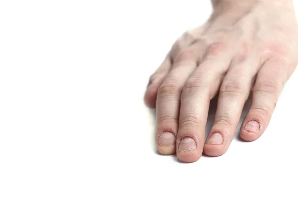 Tırnak hasarı. Tırnaklarını yemiş. Erkek manikürü. Tırnak tabağı sorunları. Erkek eli. Beyaz bir arkaplanda izole edilmiş.