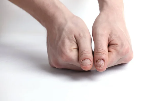 Der Mann Erlitt Einen Nagelschaden Gebissene Nägel Man Maniküre Nagelplattenprobleme — Stockfoto