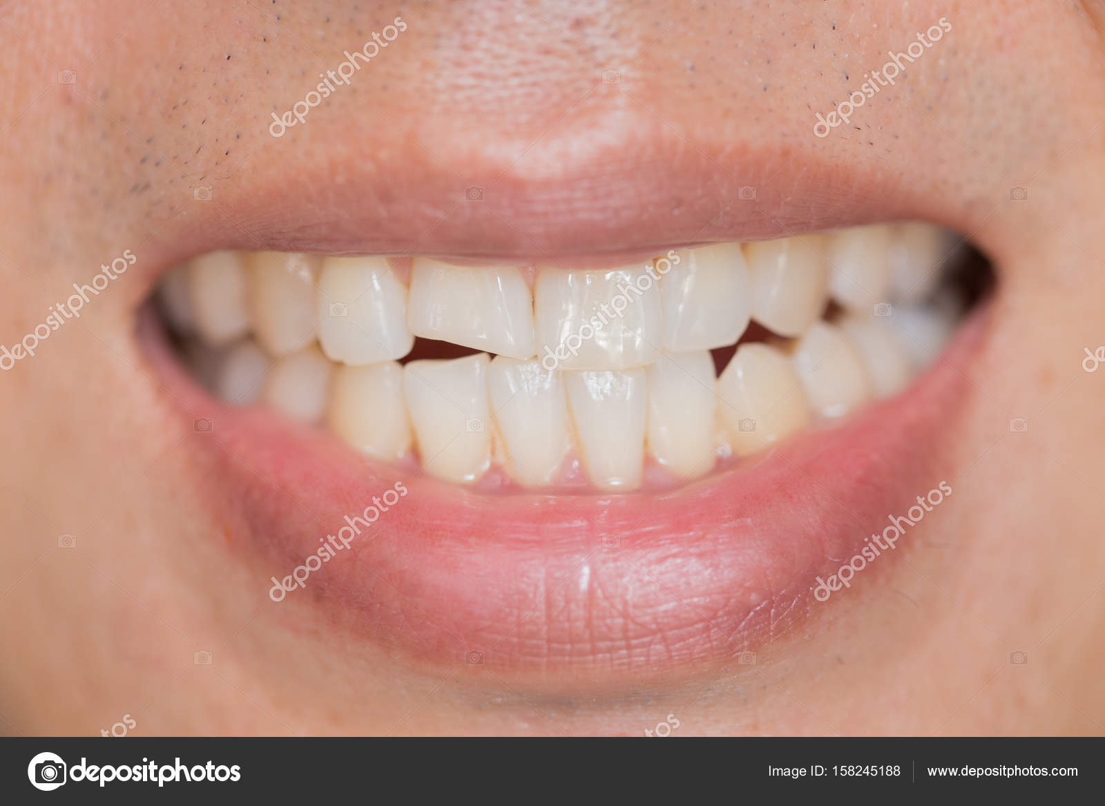 болят два передних зуба