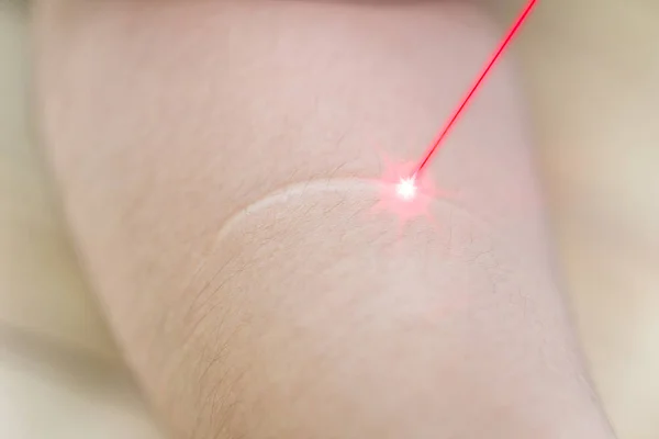 Keloïde ou cicatrice avec laser enlever la technologie de soins de la peau — Photo