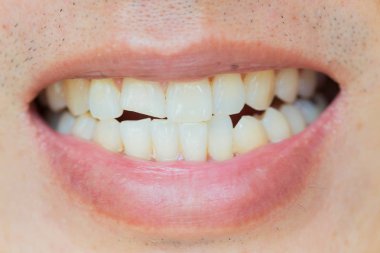 Diş yaralanma ya da diş erkek'Breaking. 