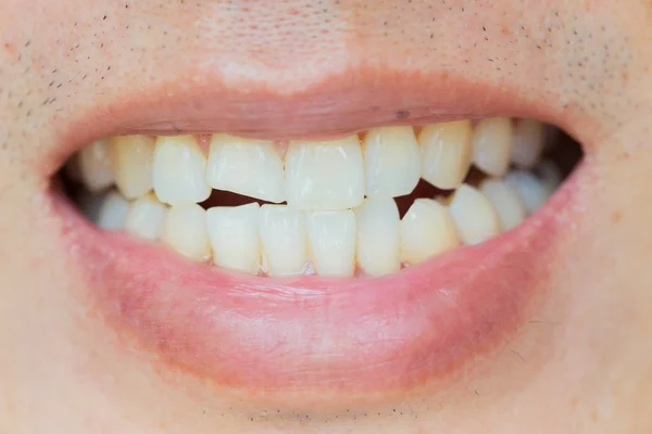 Fogak sérülés vagy törés a férfi fogak. — Stock Fotó