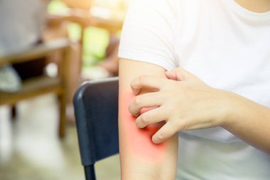 Dermatit deri Anti: kadın el kaşıntı scrashing kırmızı kol cilt