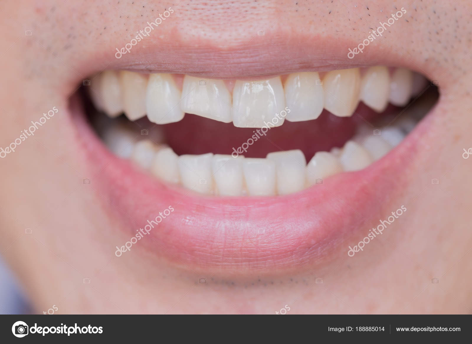 К чему снятся сломанные передние зубы. К чему снится выпадение зуба. К чему снятся сломанные передние зубы. К чему снятся сломанные передние зубы. Заместительная резорбция корня зуба.