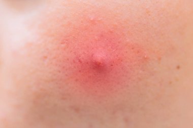 Closeup Big Acne Head skin Inflammation problem clipart