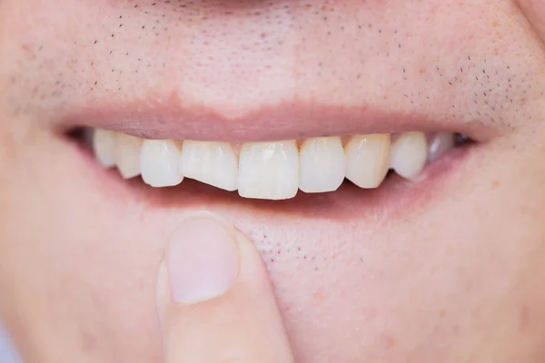 Man Gebroken Tanden Beschadigd Gebarsten Voortand Noodzaak Tandarts Corrigeren Repareren — Stockfoto