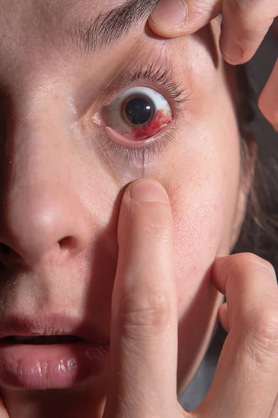 Hemorrhage in the eye of a girl. Abrasion of the cornea. Macro.