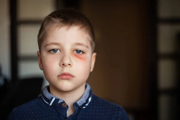 Un ragazzo con un occhio nero — Foto Stock