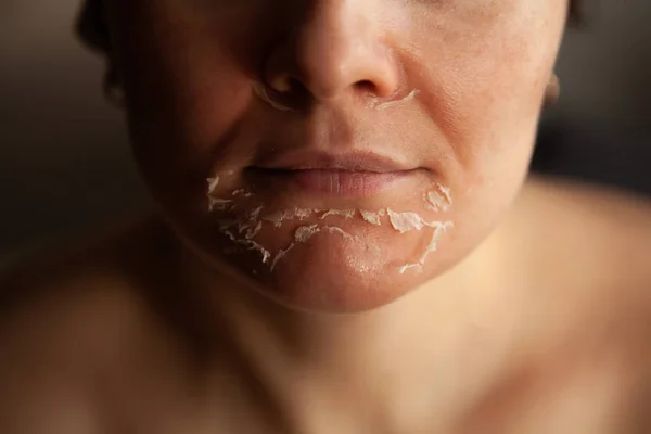 Retinoic face peeling. Woman's face after chemical peeling. Flaky skin on the face — Stock Photo, Image