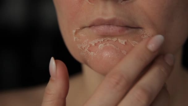 Ženská Tvář Chemickém Loupání Loupání Kůže Obličeji Exfoliace Staré Kůže — Stock video