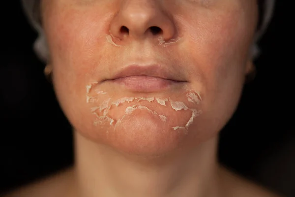 Skala huden i ansiktet. Kvinnans ansikte efter kemisk peeling. Exfoliering av gammal hud. — Stockfoto