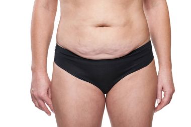 Kadın sarkık göbeği