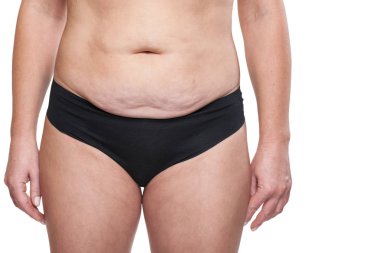 Kadın sarkık göbeği