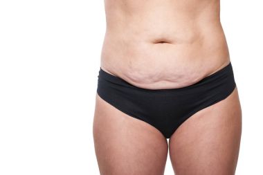 Kadın sarkık göbeği