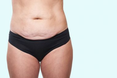 Kadın sarkık göbeği