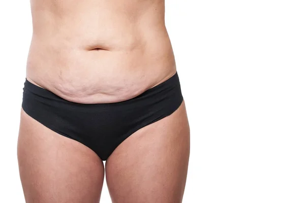 Kadın sarkık göbeği