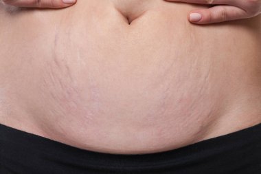 Kadın sarkık göbeği