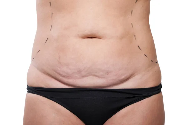 Female saggy belly — Stock Photo, Image