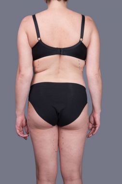 Kadın iç çamaşırı işaretleri estetik ameliyat