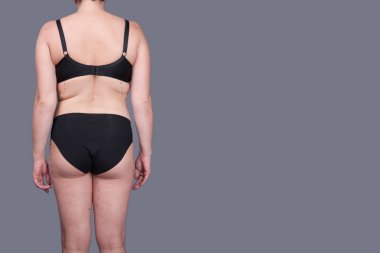 Kadın iç çamaşırı işaretleri estetik ameliyat