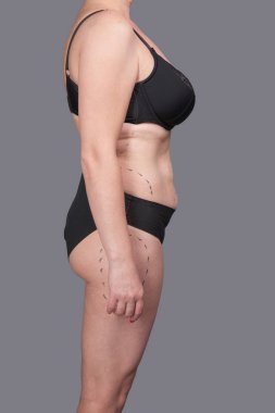 Kadın iç çamaşırı işaretleri estetik ameliyat