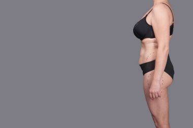 Kadın iç çamaşırı işaretleri estetik ameliyat