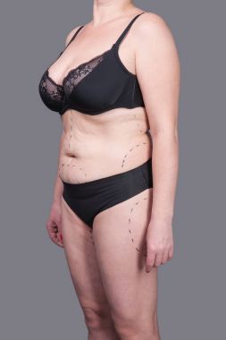 Kadın iç çamaşırı işaretleri estetik ameliyat