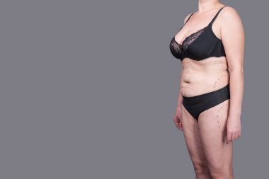 Kadın iç çamaşırı işaretleri estetik ameliyat