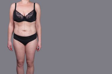 Kadın iç çamaşırı işaretleri estetik ameliyat