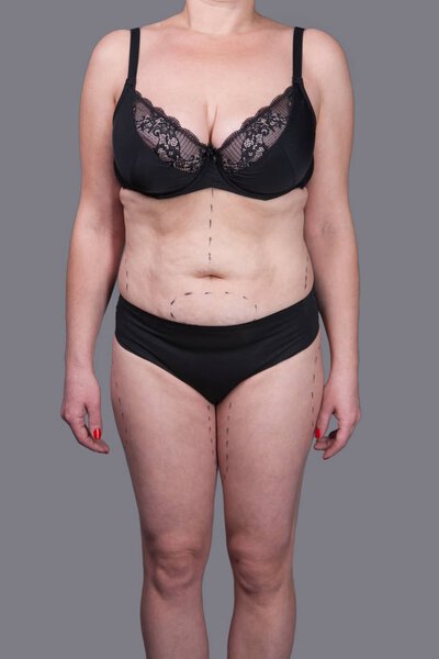 Woman in underwear with marks for plastic surgery